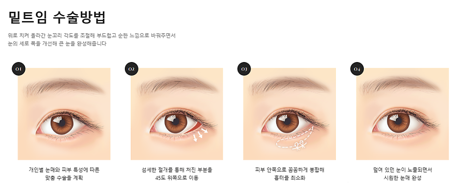 트임이 필요한 눈매와 트임 수술법 관련 이미지 9