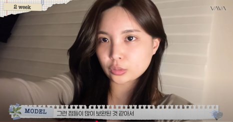 쌍수 재수술 성공기 ｜ 졸려보이는 눈 세미아웃으로 예뻐진 리얼 Before & After 관련 이미지 12