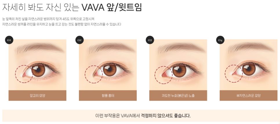 If You’re Concerned About a Tight-Looking Eye Shape | When Medial Epicanthoplasty & Upper Epicanthoplasty Are Needed and How They Differ at 바바성형외과 image 6