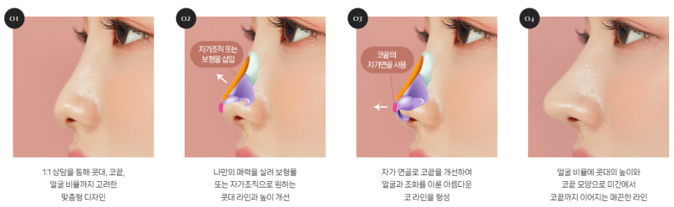 복코, 매부리코, 낮은코 | 바바성형외과 유형별 코성형, 내 코에 맞는 방향 찾기 관련 이미지 4