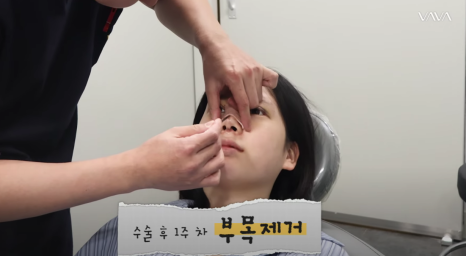 바바성형외과 눈&middot;코 성형 한 달 차 리얼 케이스 (윈터, 카리나 코) 관련 이미지 12