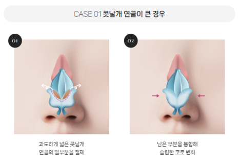 복코, 매부리코, 낮은코 | 바바성형외과 유형별 코성형, 내 코에 맞는 방향 찾기 관련 이미지 6