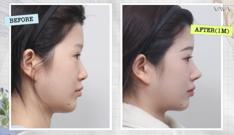 압구정 바바성형외과 자가늑 코성형 후기｜복코&middot;매부리코 교정 한달차 변화 관련 이미지 2
