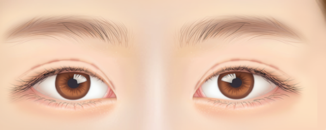 쌍꺼풀 재수술, 흉터 없이 가능할까? 관련 이미지 7