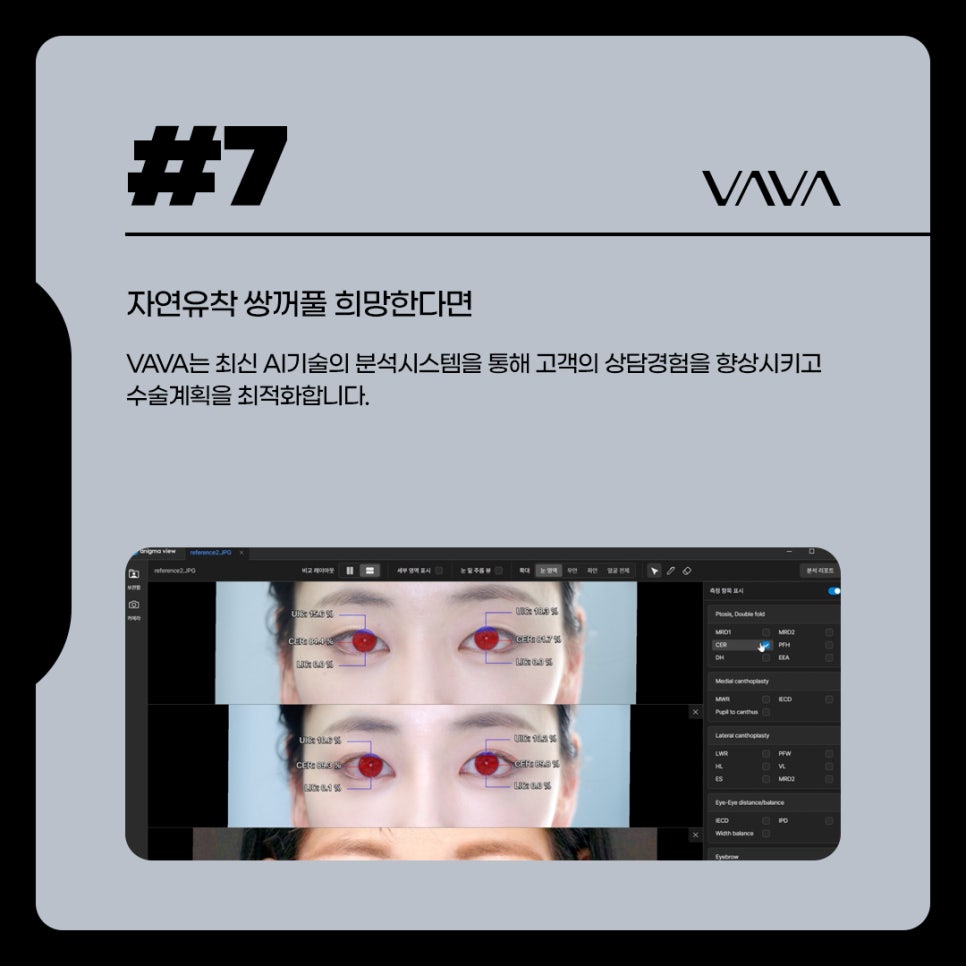 자연유착 쌍꺼풀 내게 어울리는 비율로 관련 이미지 7