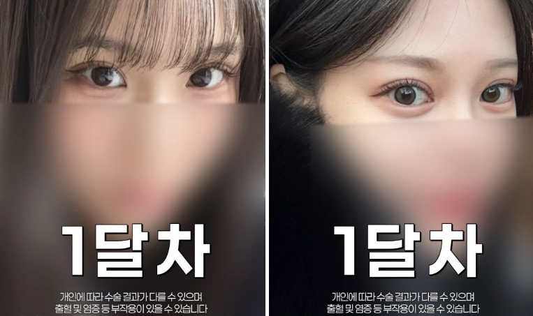 여름 쌍꺼풀 수술, 왜 오히려 더 추천할 수도 있을까? 바바성형외과에서 알려드립니다. 관련 이미지 12