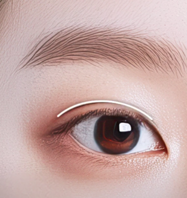 쌍수만으로 충분할까? 윗트임 병행이 필요한 경우 관련 이미지 7