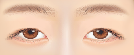 자연유착 VS 절개  어떤 기준으로 선택해야 할까? 관련 이미지 12