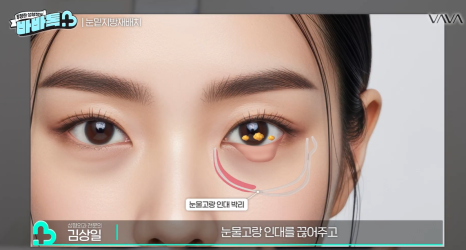 눈밑지방재배치 vs 하안검 vs 필러, 나는 어떤 케이스일까? | 압구정 바바성형외과에서 알려드립니다 관련 이미지 4