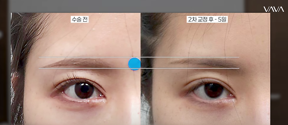 쌍수 후 생겨버린 짝눈 교정 눈의 균형을 맞추는 섬세한 방식 관련 이미지 17