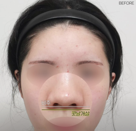 예쁜 코의 공통점은? 성형외과 원장이 알려주는 코 성형 성공하는 방법(리얼 후기 케이스) 관련 이미지 18