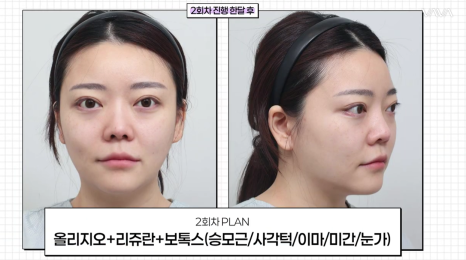 결혼식 전, 더 예쁜 나를 위한 작은 준비 (웨딩 시술 리얼 후기) 관련 이미지 15