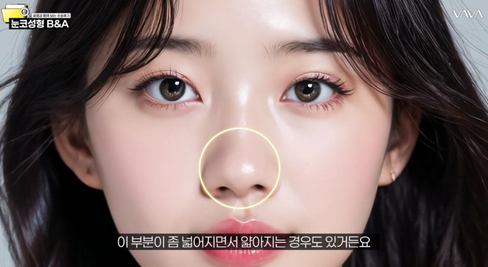 복코 매부리코 긴코 교정 ㅣ 코성형 전후 케이스 (NJZ민지 코) 관련 이미지 14