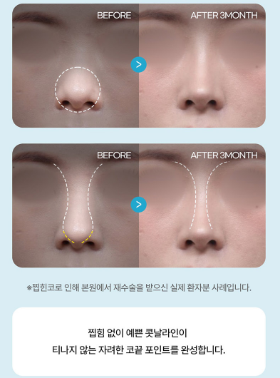 2026년 코성형 트렌드 예측콧대에서 코끝, 그리고 콧구멍까지 보는 시대 관련 이미지 3