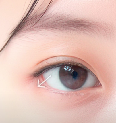 쌍수만으로 충분할까? 윗트임 병행이 필요한 경우 관련 이미지 5