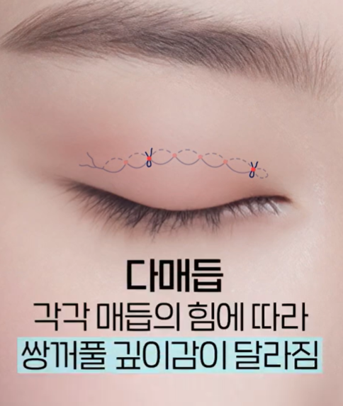 자연유착 vs 매몰 쌍꺼풀, 같은 비절개인데 왜 다를까요? 관련 이미지 8
