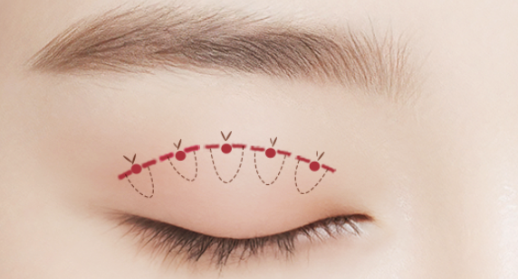 자연유착 VS 절개  어떤 기준으로 선택해야 할까? 관련 이미지 3