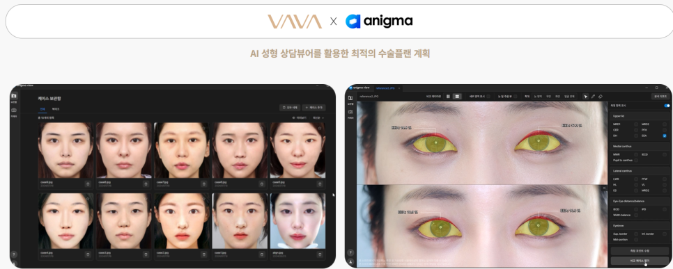 쌍꺼풀 수술 짧은 회복기 가능? 종류별 차이 완전 정리 관련 이미지 15