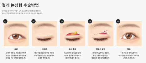 쌍꺼풀 수술만으로 충분할까? 눈 트임이 필요한 경우 관련 이미지 9