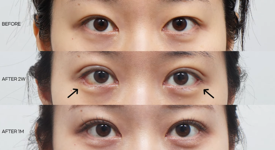 뒤밑트임 수술, 잘 되는 눈 따로 있습니다｜추천 대상&middot;부작용&middot;재유착 정리 관련 이미지 21