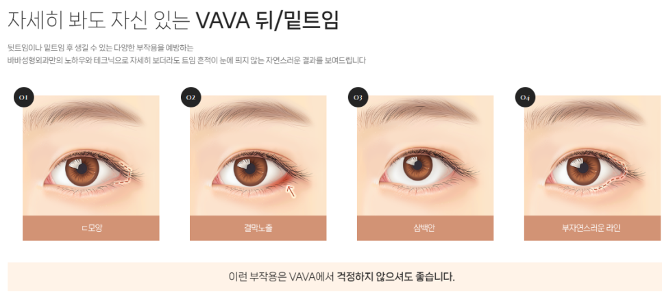 Concerned About Eyes That Look Narrow and Constricted? | When a Lateral Canthoplasty & Lower Canthoplasty May Be Needed at Baba Plastic Surgery Clinic image 6