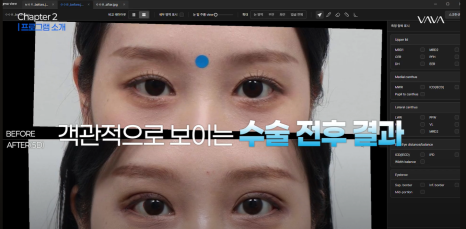 압구정 눈성형, 자연스럽게 달라지는 첫인상 관련 이미지 3