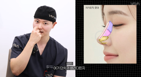 코성형 재료 총정리｜실리콘 부작용&middot;자가늑연골 와핑&middot;귀연골 흡수까지 (콧대 코끝 비교) 관련 이미지 9