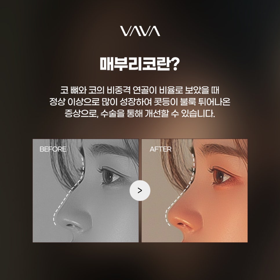 매부리코수술 교정법부터 체크할 사항 관련 이미지 2