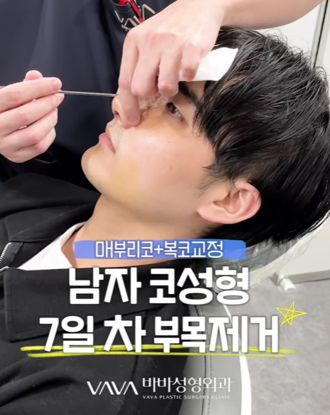 남자 코성형 리얼 후기 한 달 차 사례 비교해 보며 분석하기 관련 이미지 15