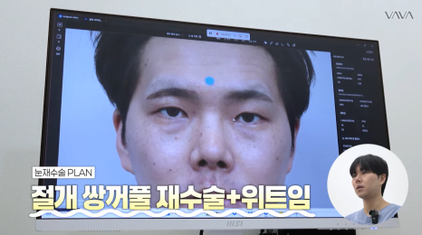 눈&middot;구축코 재수술 후기｜남자 눈코 재수술, 압구정 바바에서 달라진 이유 관련 이미지 8