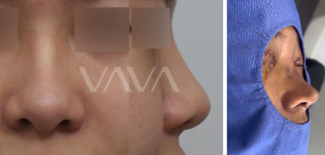 코성형 재수술, 처음보다 더 어려운 이유는? 성공하려면 이것부터! 관련 이미지 6