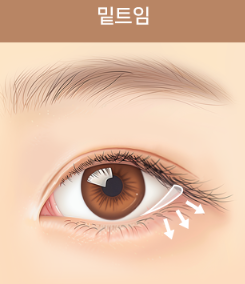 쌍꺼풀 수술만으로 충분할까? 눈 트임이 필요한 경우 관련 이미지 6