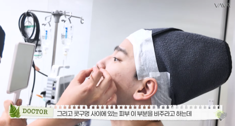 무보형물 직선라인 코성형으로 주먹코&middot;복코 개선｜압구정 바바성형외과 사례 관련 이미지 18