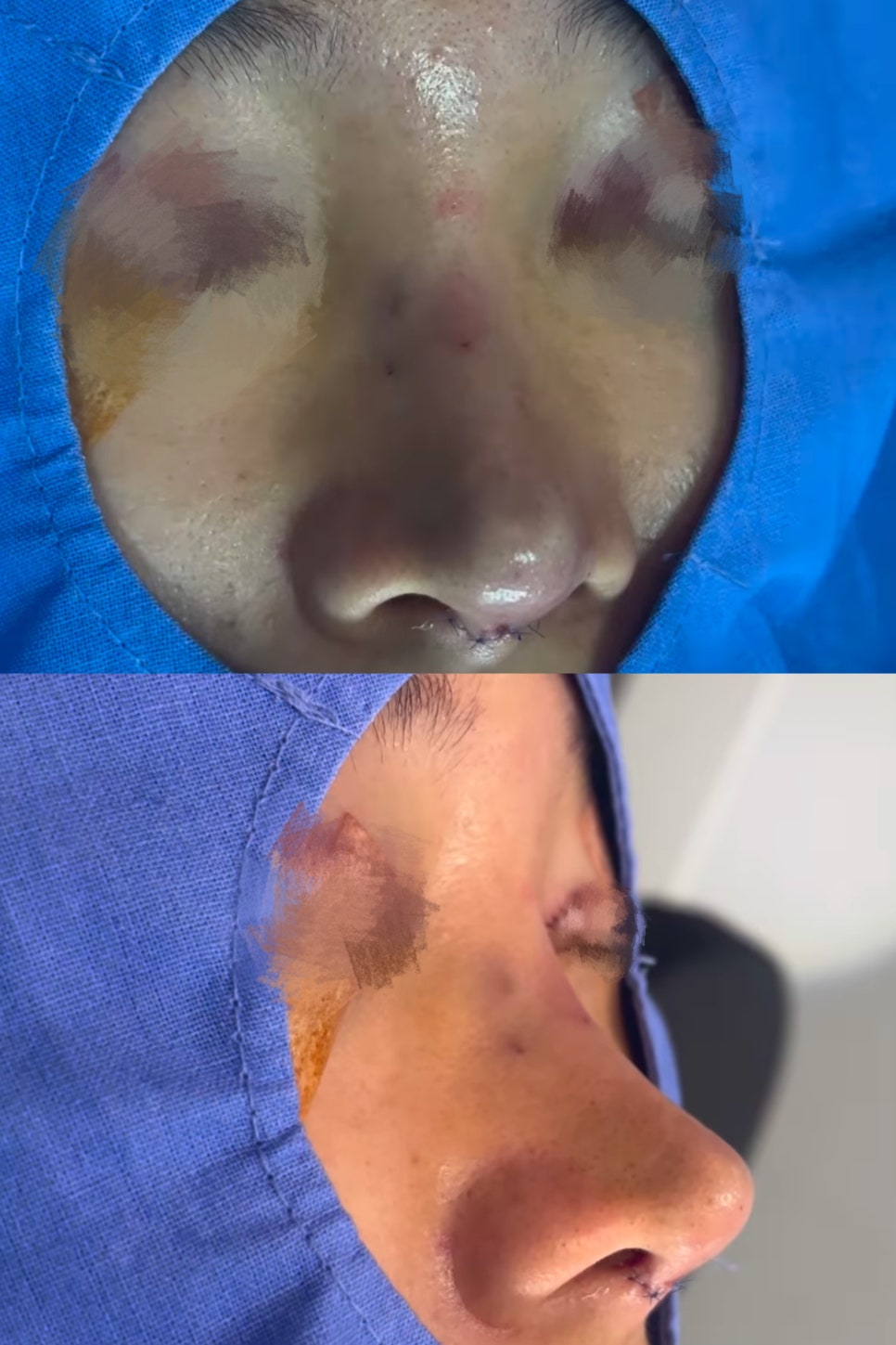 첫 재수술 실패로 잃어버린 코 라인 되찾기 관련 이미지 7