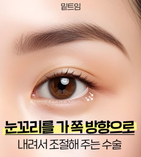 뒤밑트임 수술, 잘 되는 눈 따로 있습니다｜추천 대상&middot;부작용&middot;재유착 정리 관련 이미지 4