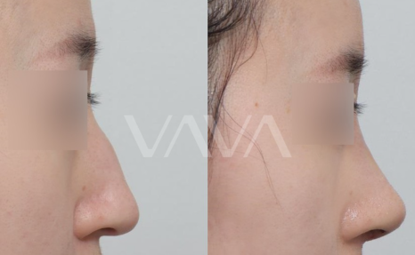 코성형 재수술, 처음보다 더 어려운 이유는? 성공하려면 이것부터! 관련 이미지 4