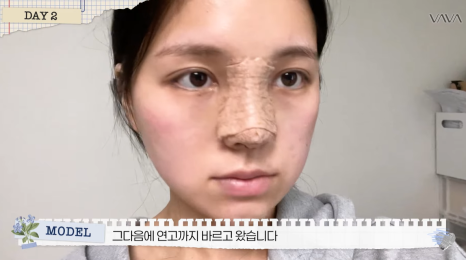 보형물 없이 선명하게｜바바성형외과 무보형물 매부리코 교정 리얼 후기 관련 이미지 11