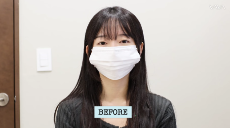 졸려보이는 눈 자연유착 밑트임 위트임으로 또렷하게 (리얼 후기) 관련 이미지 2