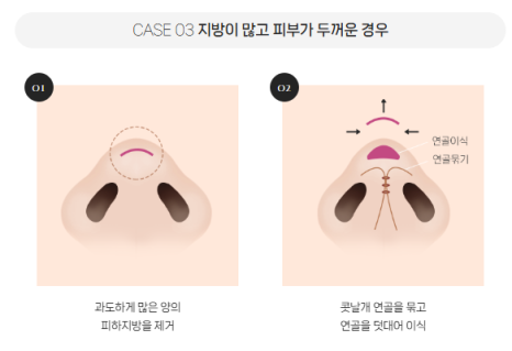 복코, 매부리코, 낮은코 | 바바성형외과 유형별 코성형, 내 코에 맞는 방향 찾기 관련 이미지 8