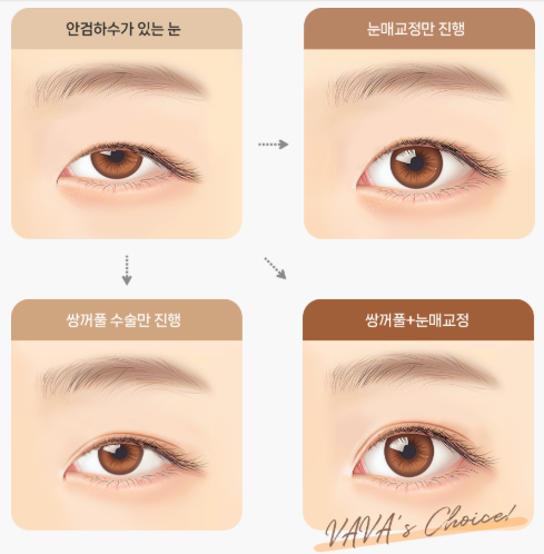 졸려 보인다는 말 자주 듣는다면? | 바바성형외과 눈매교정이 필요한 경우 관련 이미지 5