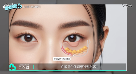 눈밑지방재배치 vs 하안검 vs 필러, 나는 어떤 케이스일까? | 압구정 바바성형외과에서 알려드립니다 관련 이미지 5