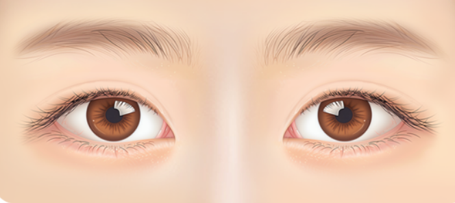 쌍꺼풀 재수술, 흉터 없이 가능할까? 관련 이미지 6