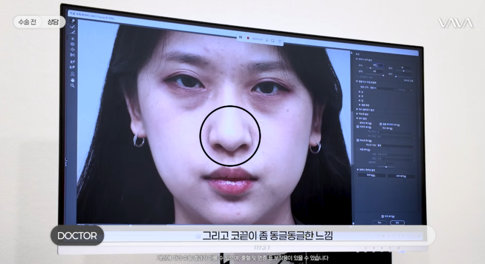 눈이랑 코 같이 하면 더 예뻐질까? ㅣ  동시성형 솔직 정리 관련 이미지 2