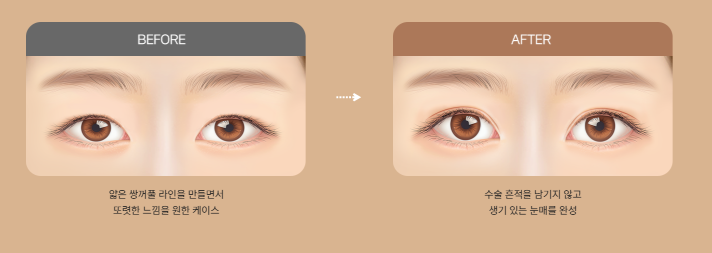 압구정 눈성형, 자연스럽게 달라지는 첫인상 관련 이미지 7