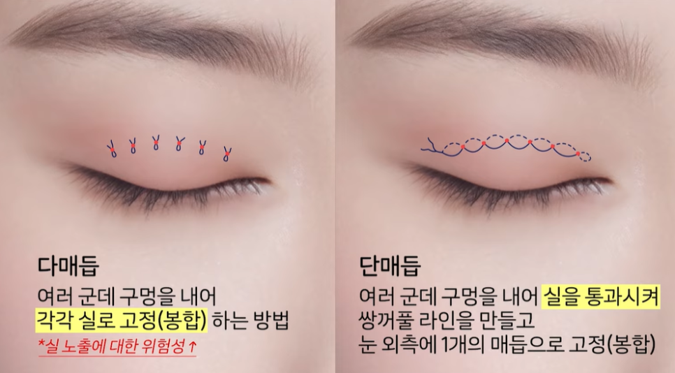 자연유착 VS 절개  어떤 기준으로 선택해야 할까? 관련 이미지 4