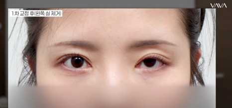 쌍수 후 생겨버린 짝눈 교정 눈의 균형을 맞추는 섬세한 방식 관련 이미지 13
