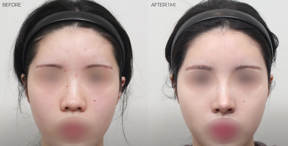 예쁜 코의 공통점은? 성형외과 원장이 알려주는 코 성형 성공하는 방법(리얼 후기 케이스) 관련 이미지 17