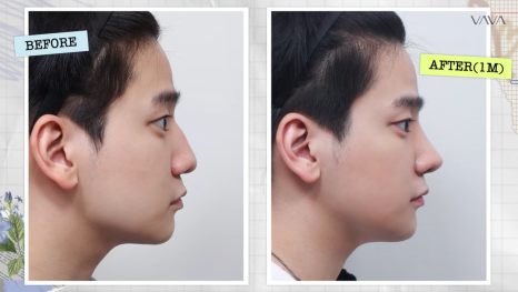 무보형물 직선라인 코성형으로 주먹코&middot;복코 개선｜압구정 바바성형외과 사례 관련 이미지 2