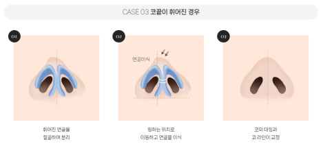 복코, 매부리코, 낮은코 | 바바성형외과 유형별 코성형, 내 코에 맞는 방향 찾기 관련 이미지 18