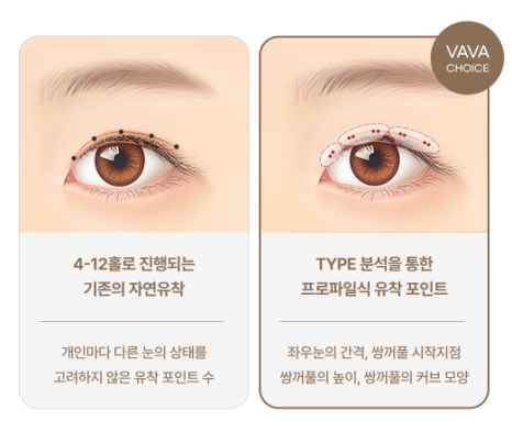 겨울방학 쌍꺼풀 수술, 이것만은 꼭 알아두세요｜쌍꺼풀 수술 가이드 관련 이미지 7